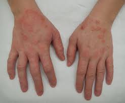 アトピー性皮膚炎の市場規模は、2030年には214億米ドルに達すると予測されています。
