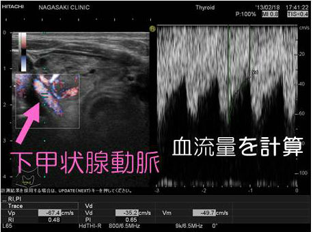 バセドウ病（甲状腺機能亢進症）再発・抗甲状腺薬の効き易さの予測